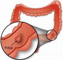 Polyp đại trực tràng có nguy hiểm không?