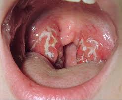 Ung Thư Amidan là một bệnh hiếm gặp
