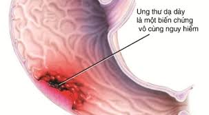 Biến chứng của bệnh loét dạ dày tá tràng