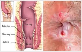 Rò hậu môn Mạch lươn Nam dược thần hiệu