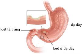 Bệnh viêm loét dạ dày tá tràng và quan điểm YHCT