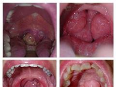 Ung thư mũi họng